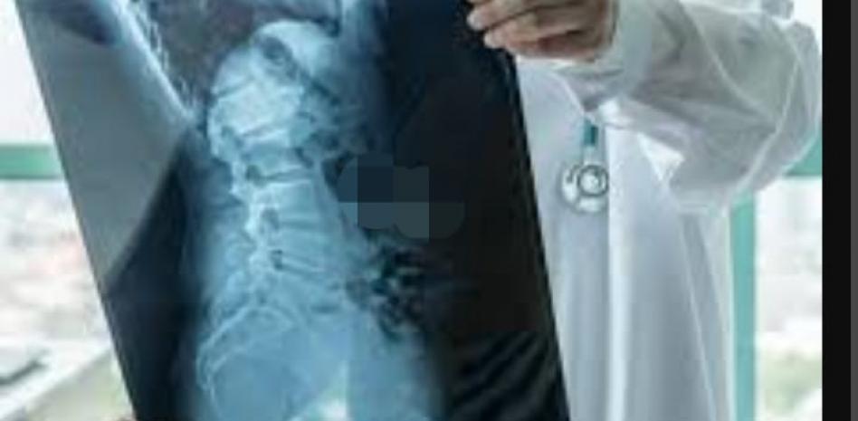 Se debe reconocer a la Atrofia Muscular Espinal (AME), como enfermedad rara para garantizar tratamiento oportuno